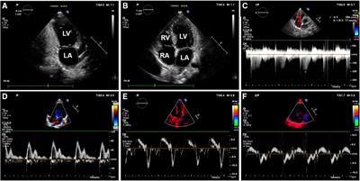 Comparison of two echocardiography-based methods for evaluating pediatric left ventricular diastolic dysfunction